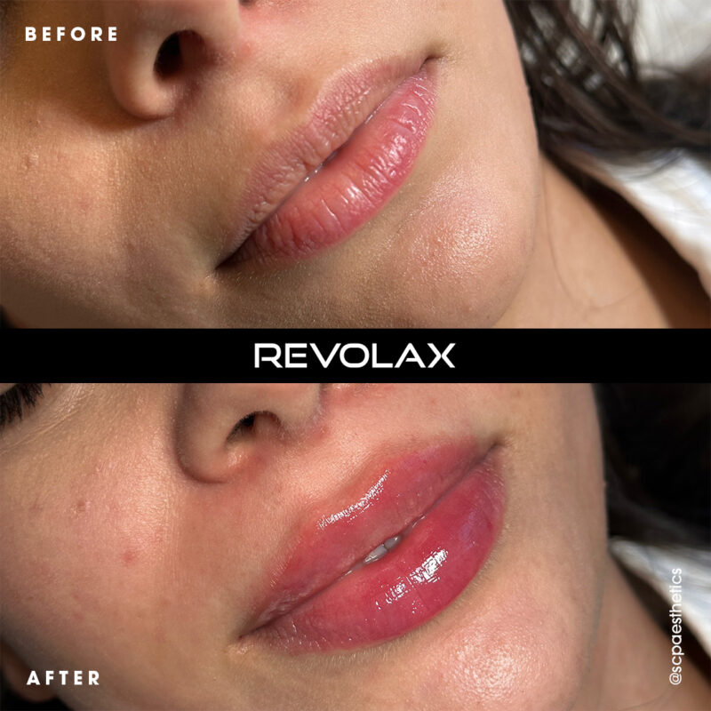 REVOLAX-FINE-3